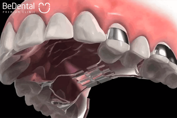 Nong hàm trong có thể kéo dài từ 4-9 tháng