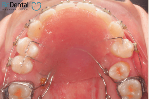 Nong hàm và chỉnh nha răng phối hợp