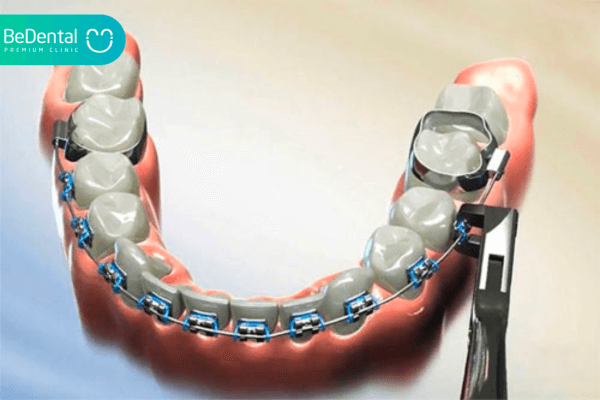 Kỹ thuật lắp band niềng răng sẽ không gây đau nếu khoảng cách giữa các răng đã thưa sẵn, không phải đặt thun tách kẽ.