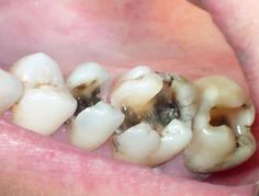 Điều trị tuỷ răng bị thối!