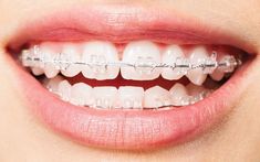 Các loại niềng răng phổ biến và chi phí