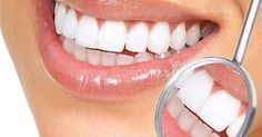 tẩy trắng răng có được chi trả bảo hiểm y tế không