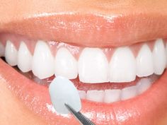 Bọc răng sứ cho răng sâu bao nhiêu tiền và quy trình bọc răng sứ cho răng sâu!