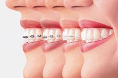 các loại niềng răng phổ biến và chi phí