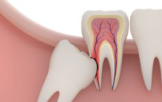 Nhổ răng khôn hết bao nhiêu thời gian & bao lâu hết đau?