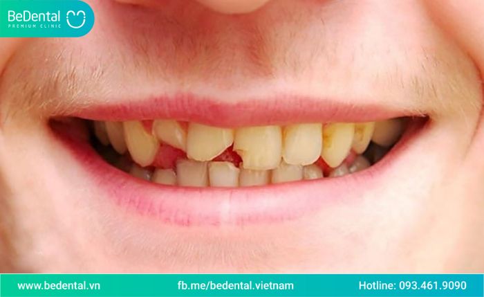 Tai nạn gãy răng cần làm gì? 1 số Tips cho các bạn tham khảo