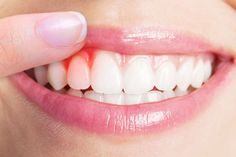 Răng nanh nhọn là gì?