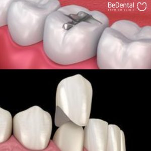 so sánh bọc răng sứ và trám răng/hàn răng