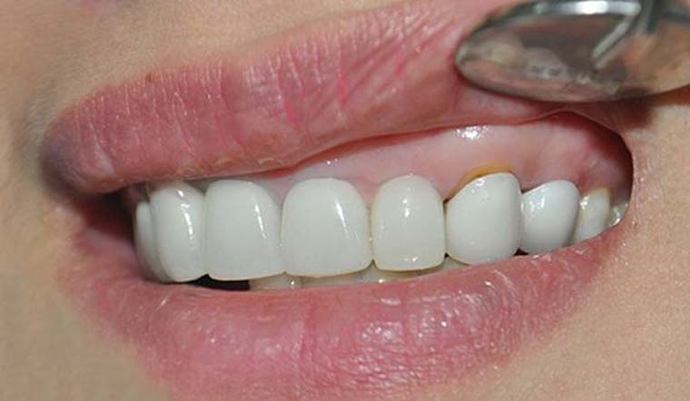 8 Cách chữa chân răng đen tại nhà mà bạn không nên bỏ qua